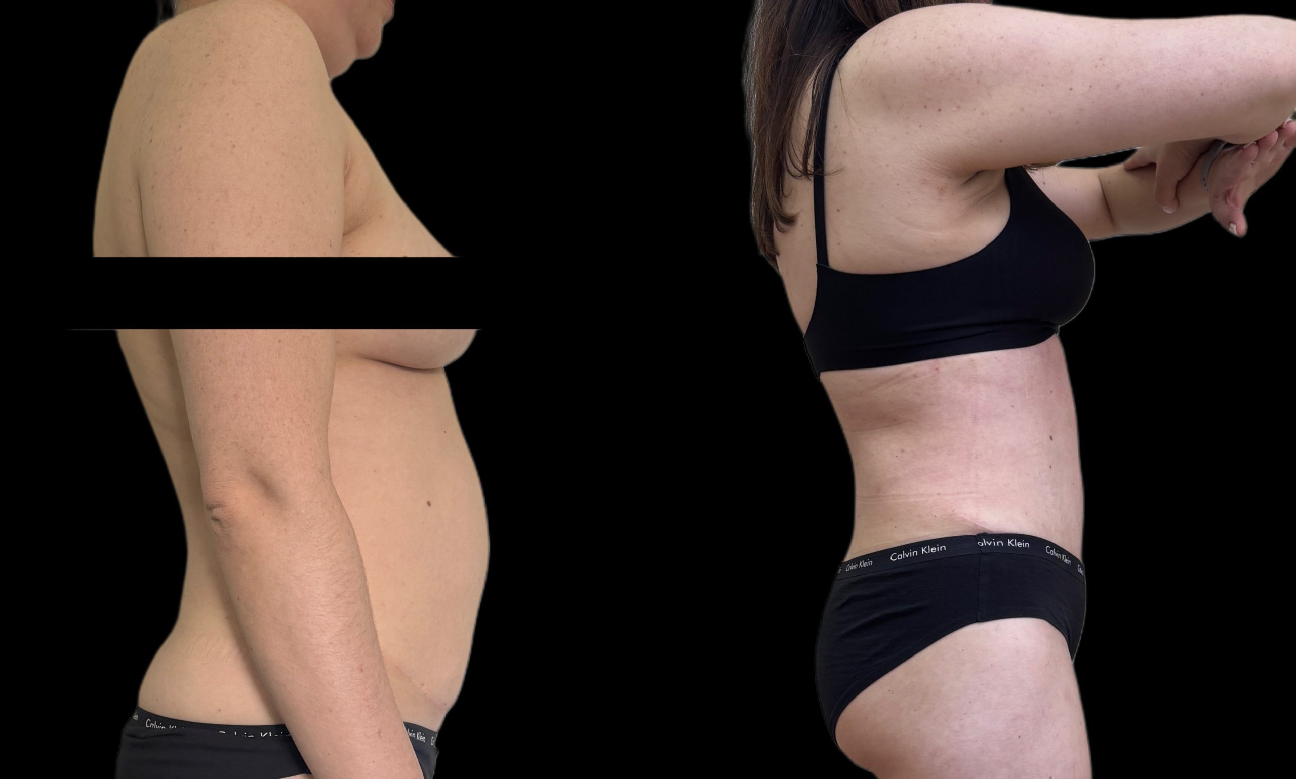 Миниабдоминопластика 01