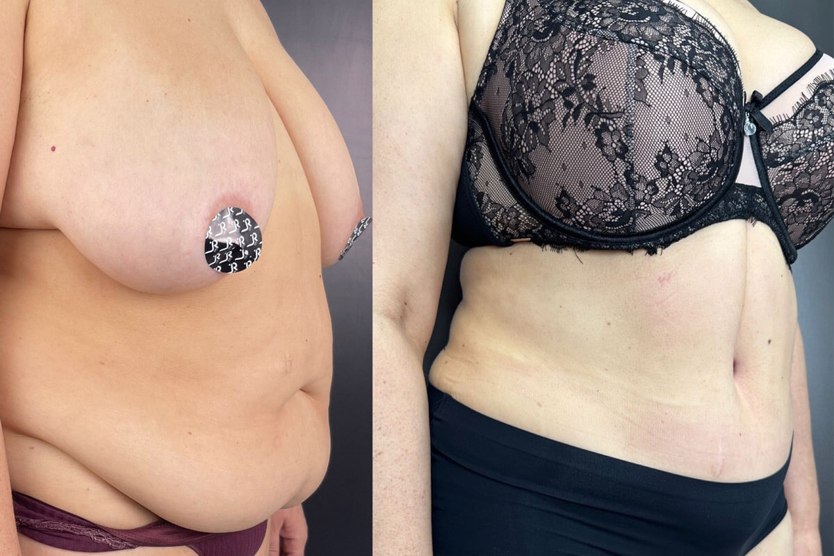 Абдоминопластика с переносом пупка 01