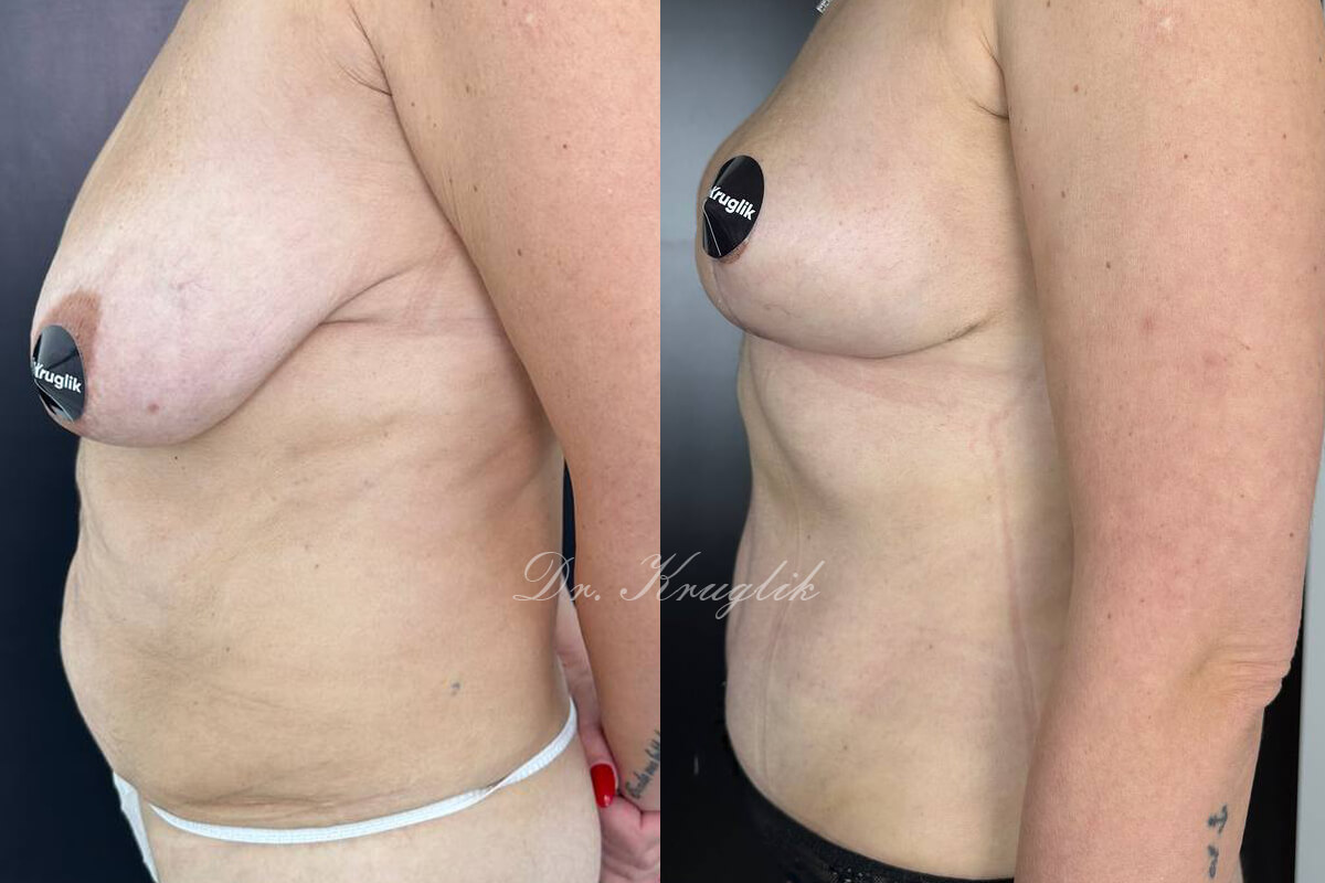 Подтяжка груди (мастопексия) 01