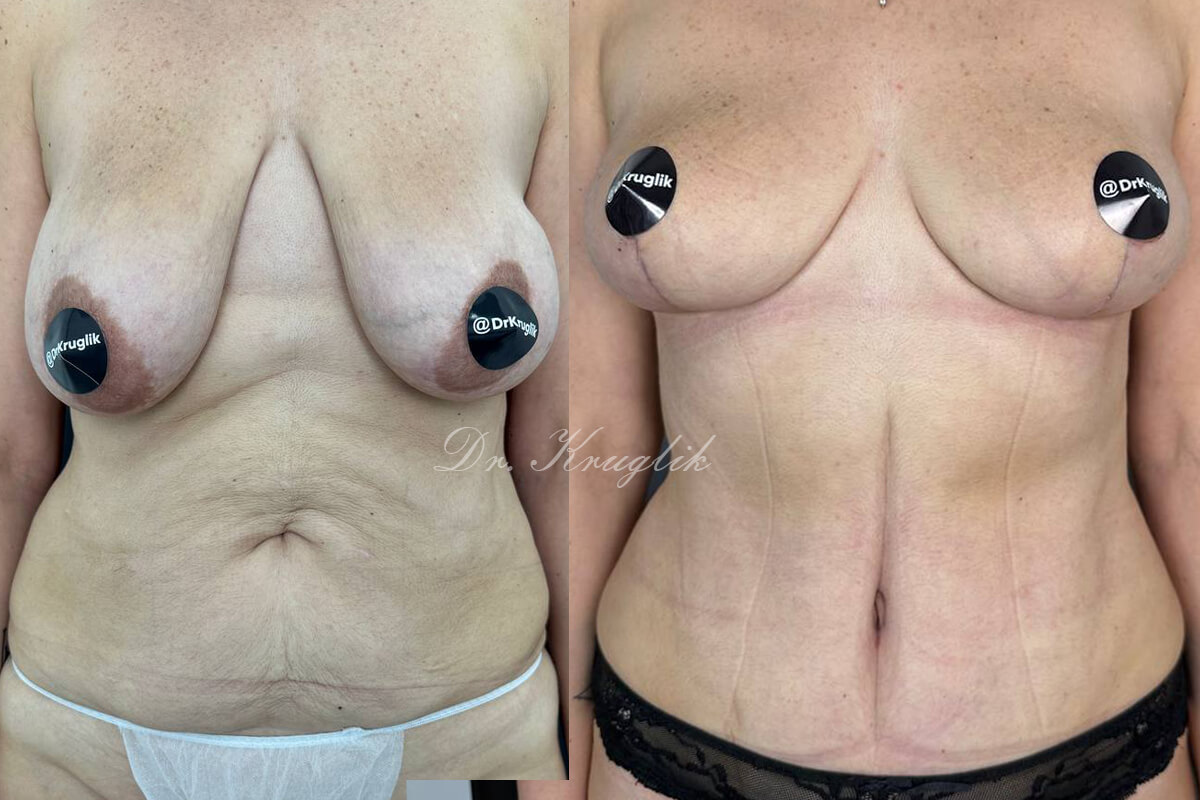 Подтяжка груди (мастопексия) 01