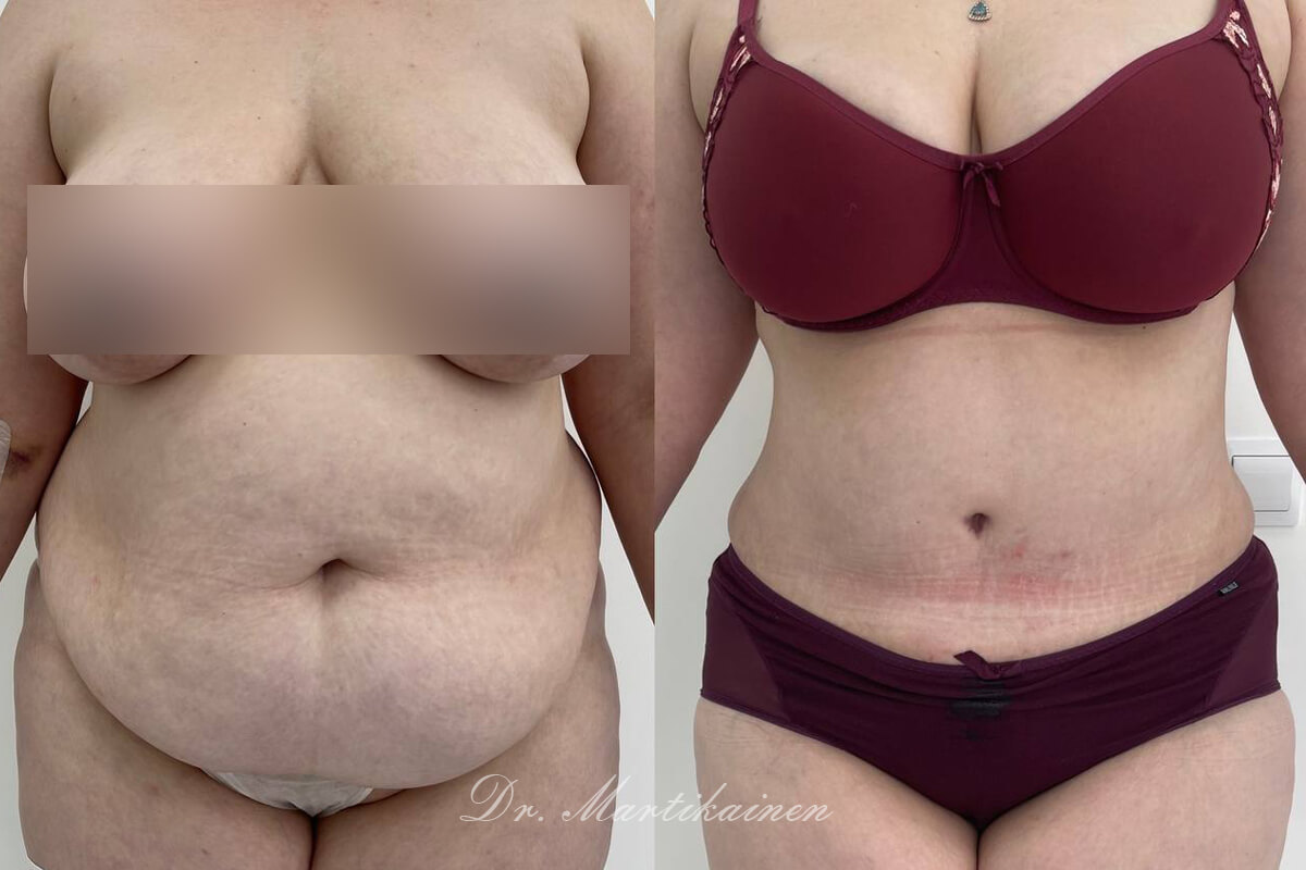 Абдоминопластика с переносом пупка 01