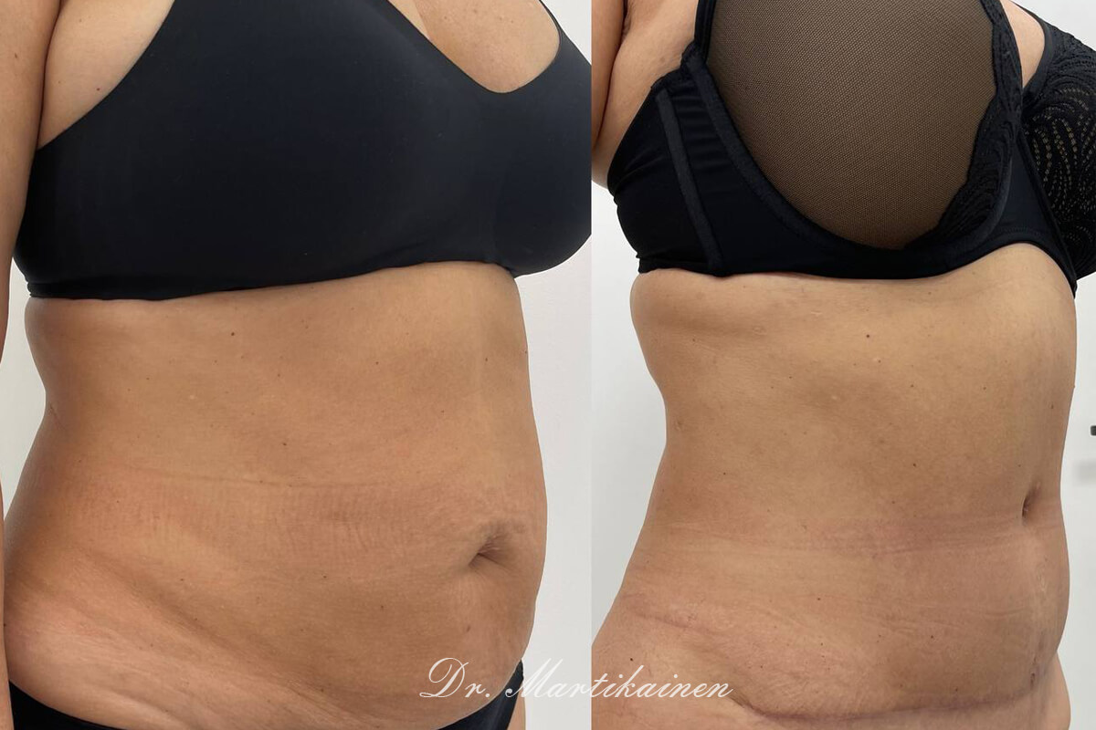 Абдоминопластика с переносом пупка 01