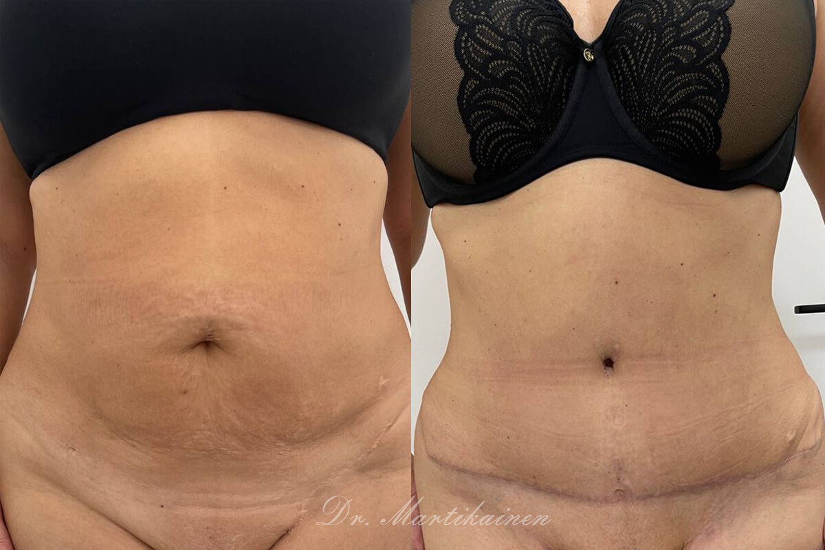 Абдоминопластика с переносом пупка 01