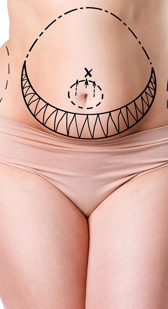 Абдоминопластика с переносом пупка