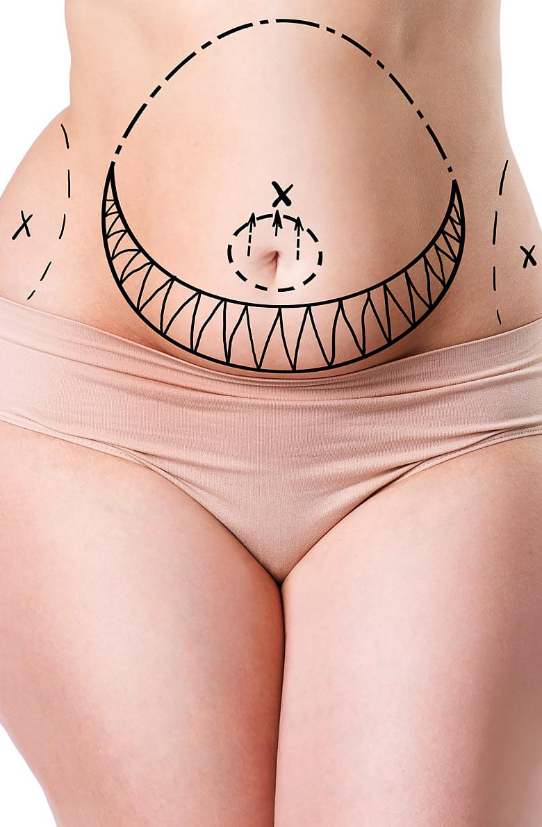 Абдоминопластика с переносом пупка