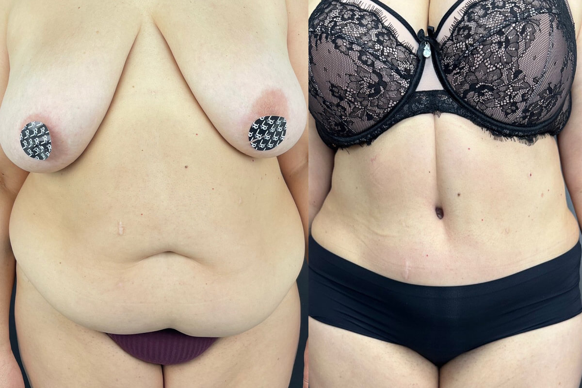 Абдоминопластика с переносом пупка 01