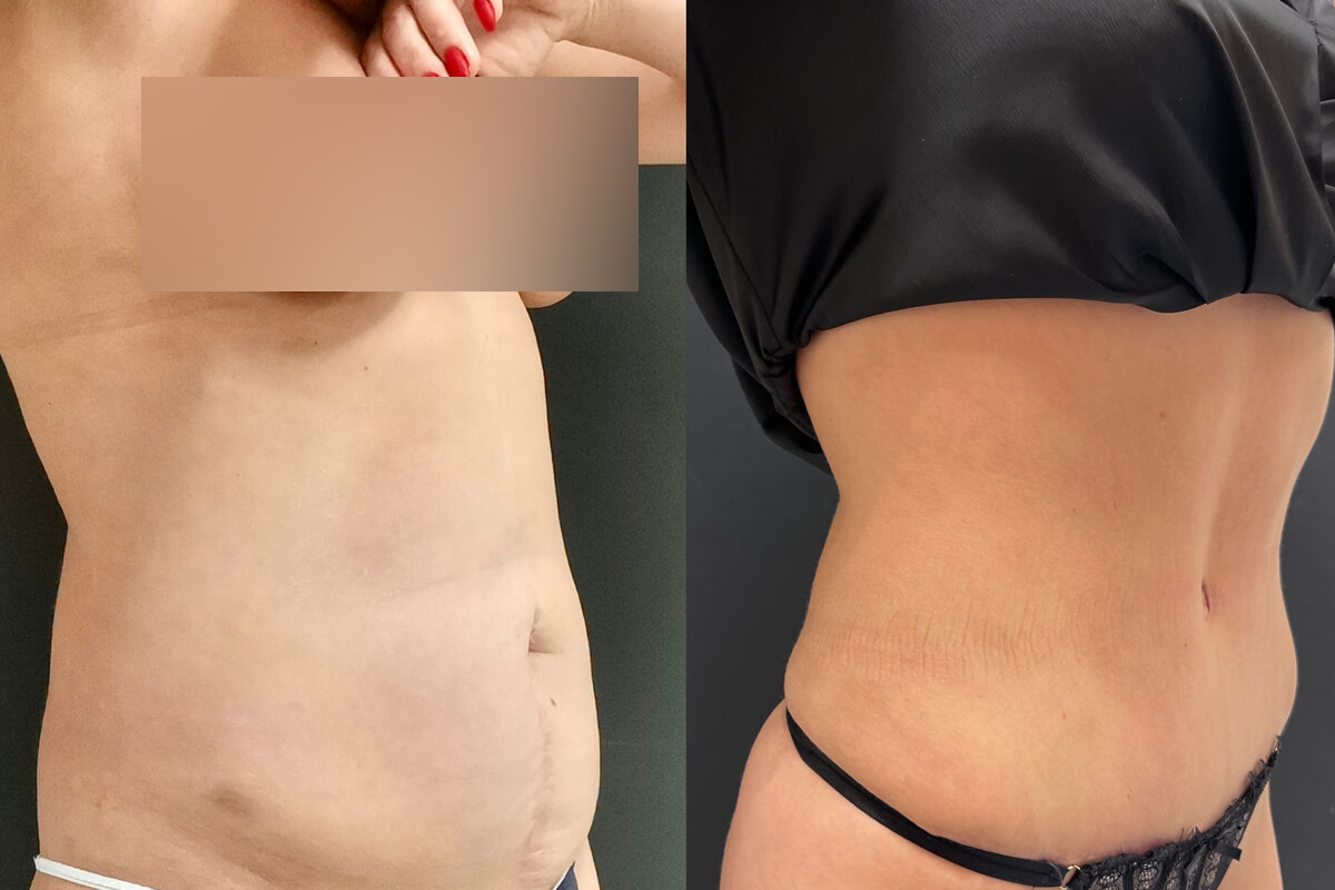 Абдоминопластика с переносом пупка 01