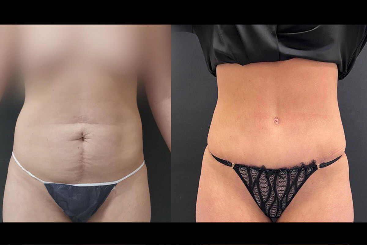 Ушивание диастаза 01