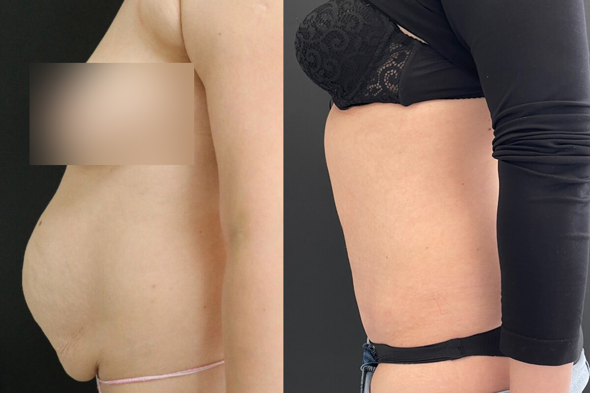 Абдоминопластика с переносом пупка 01