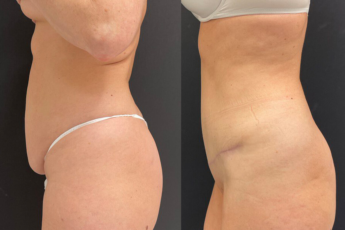 Ушивание диастаза 01