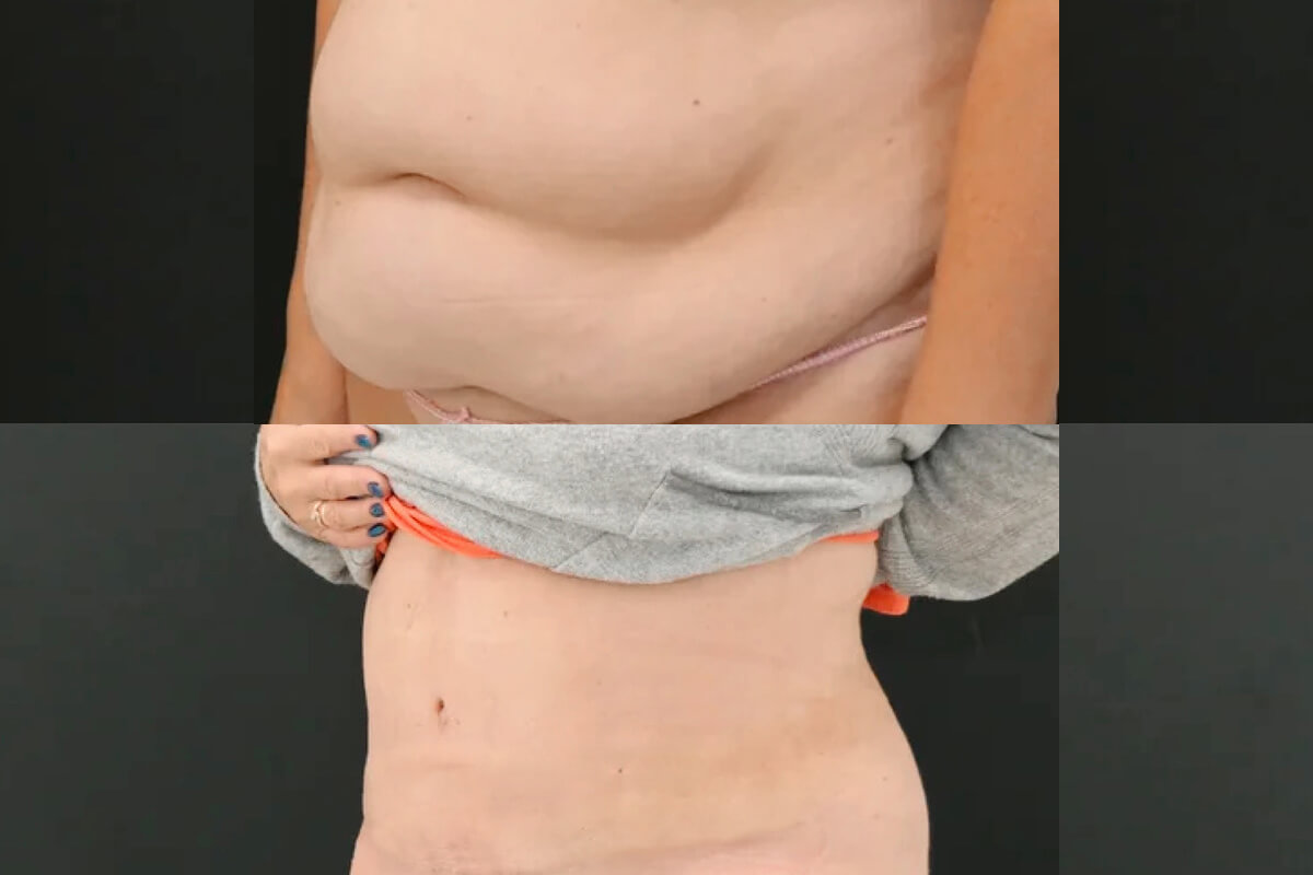 Абдоминопластика с переносом пупка 01