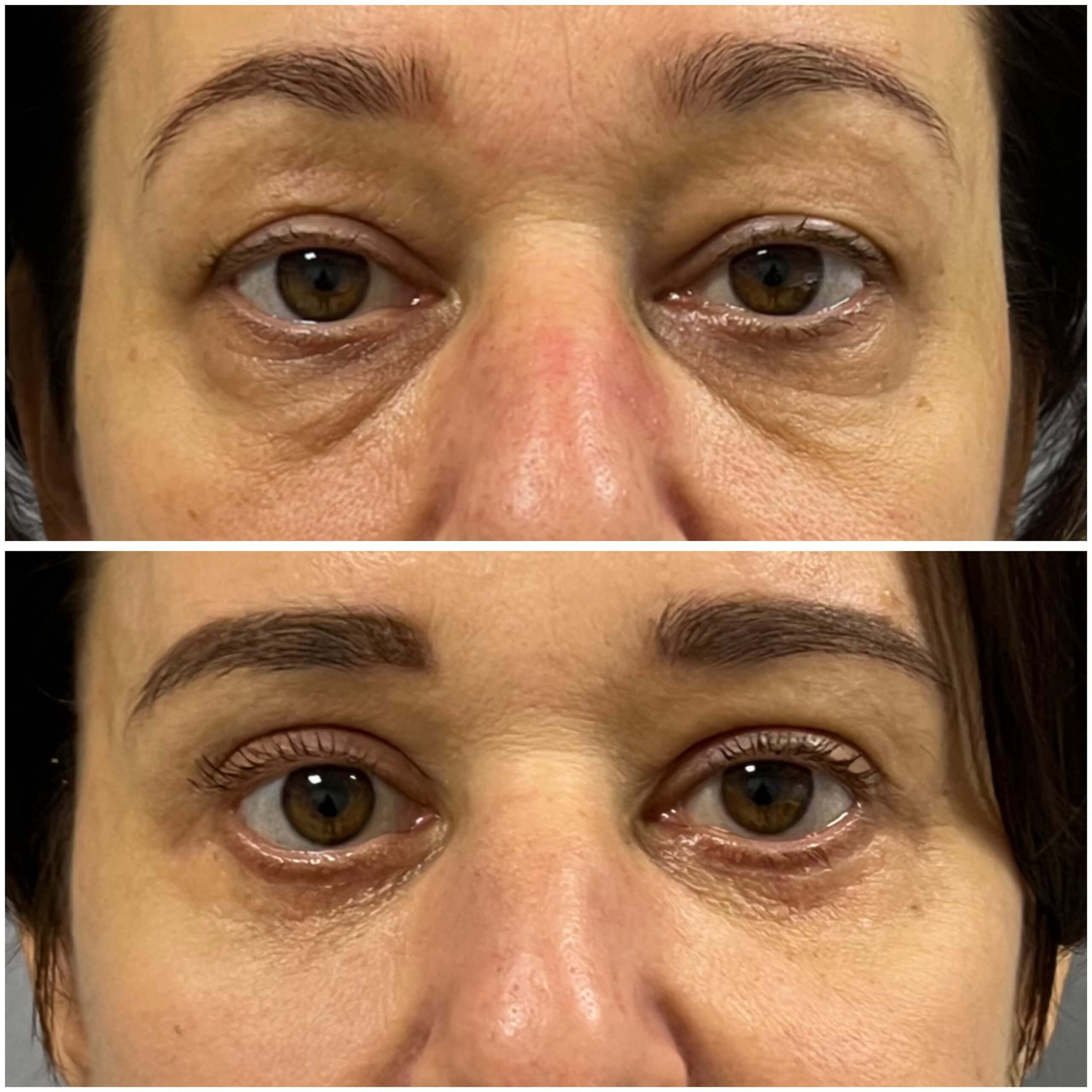 Нижняя блефаропластика 01