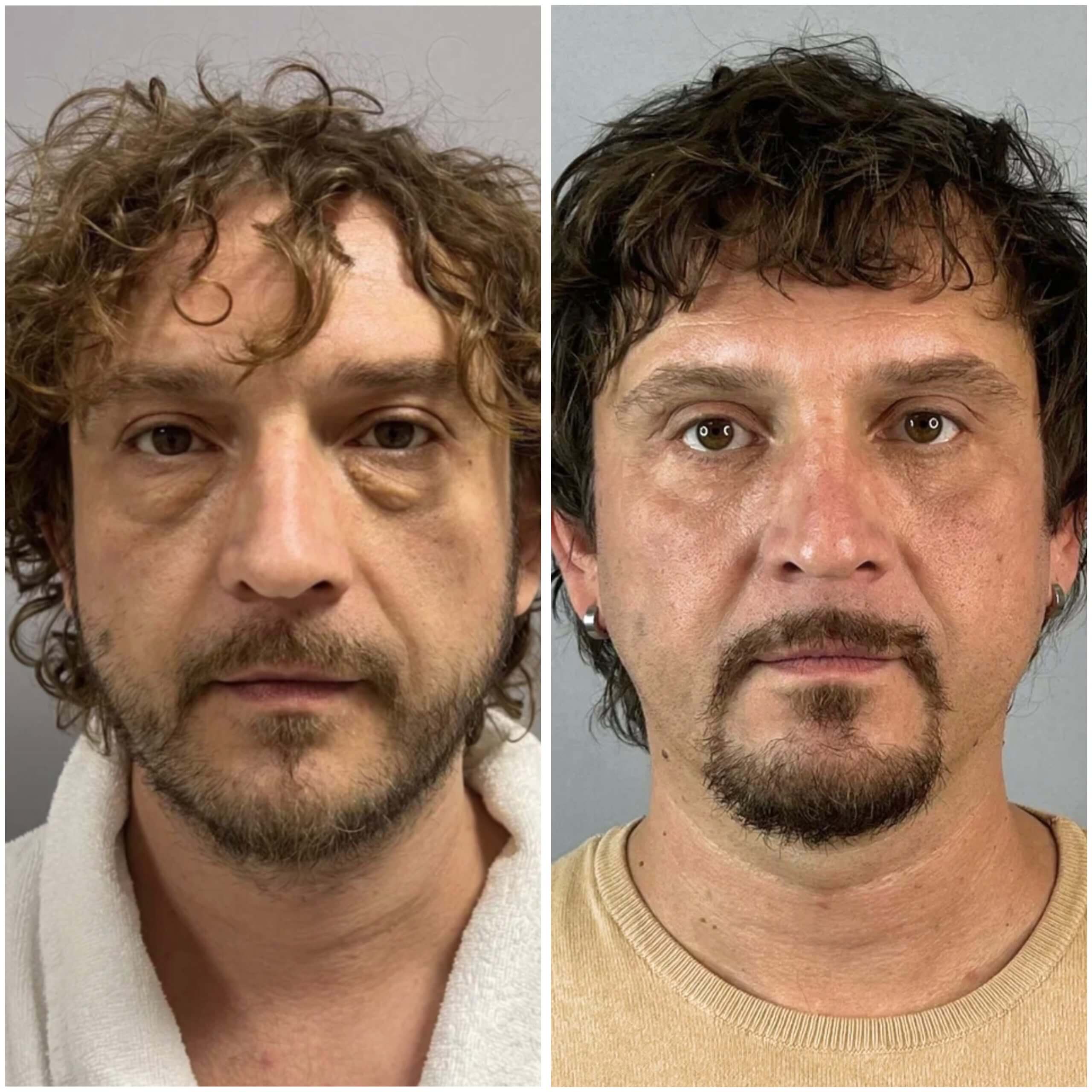 Нижняя блефаропластика 01