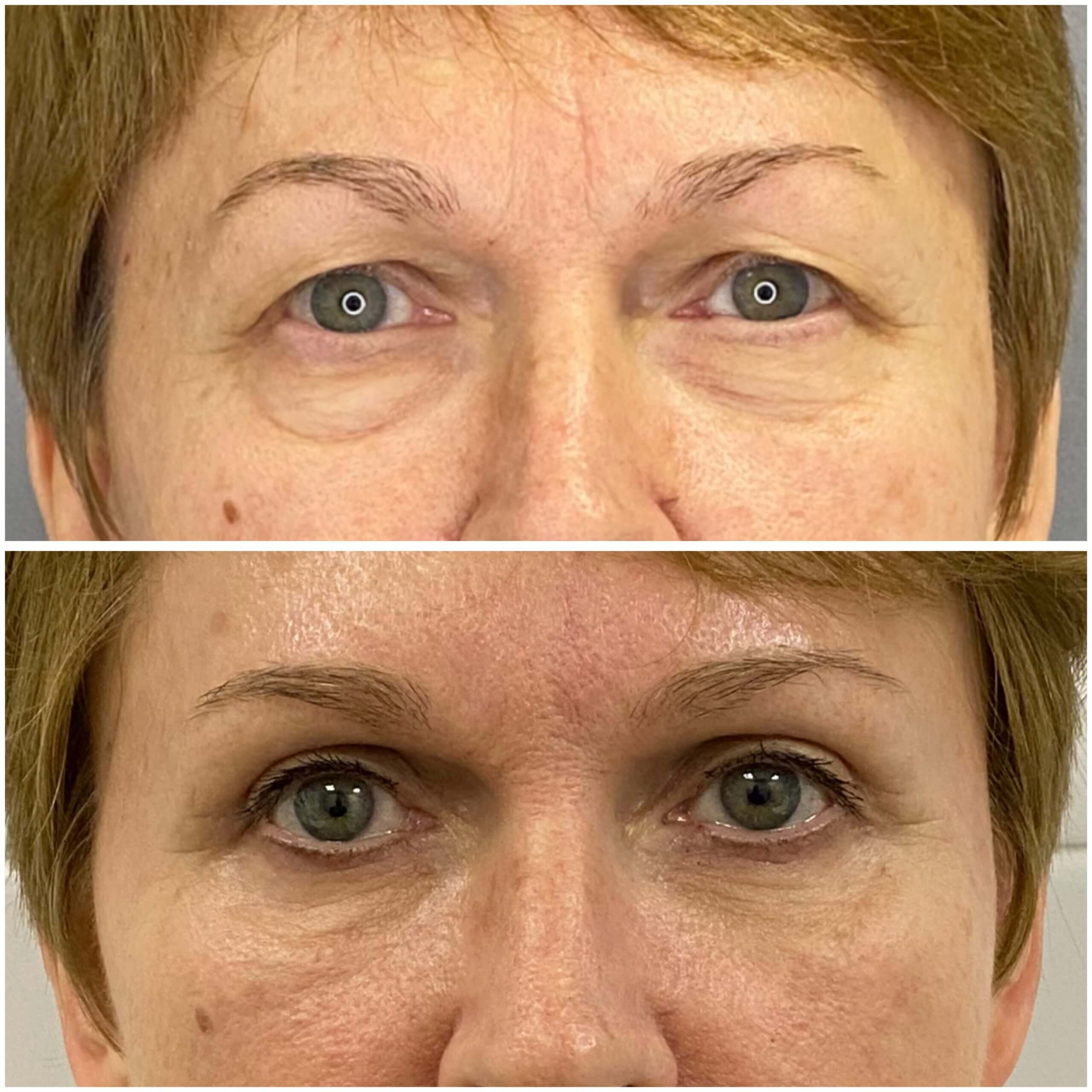 Нижняя блефаропластика 01