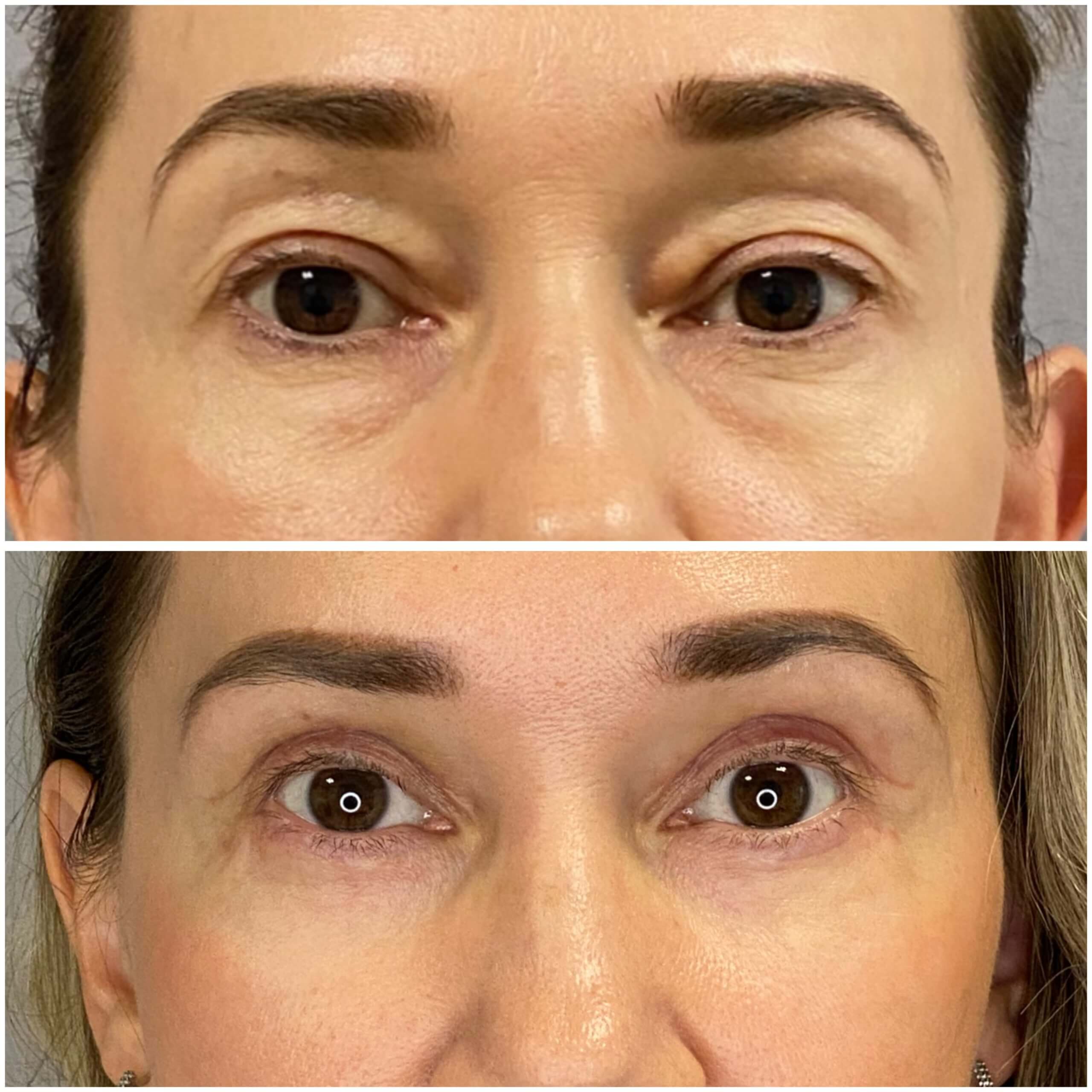 Нижняя блефаропластика 01