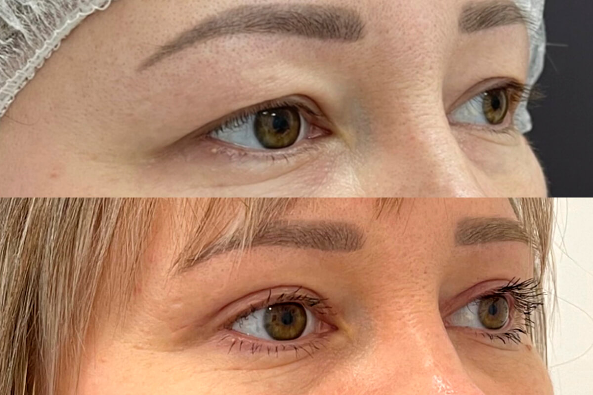 Нижняя блефаропластика 01