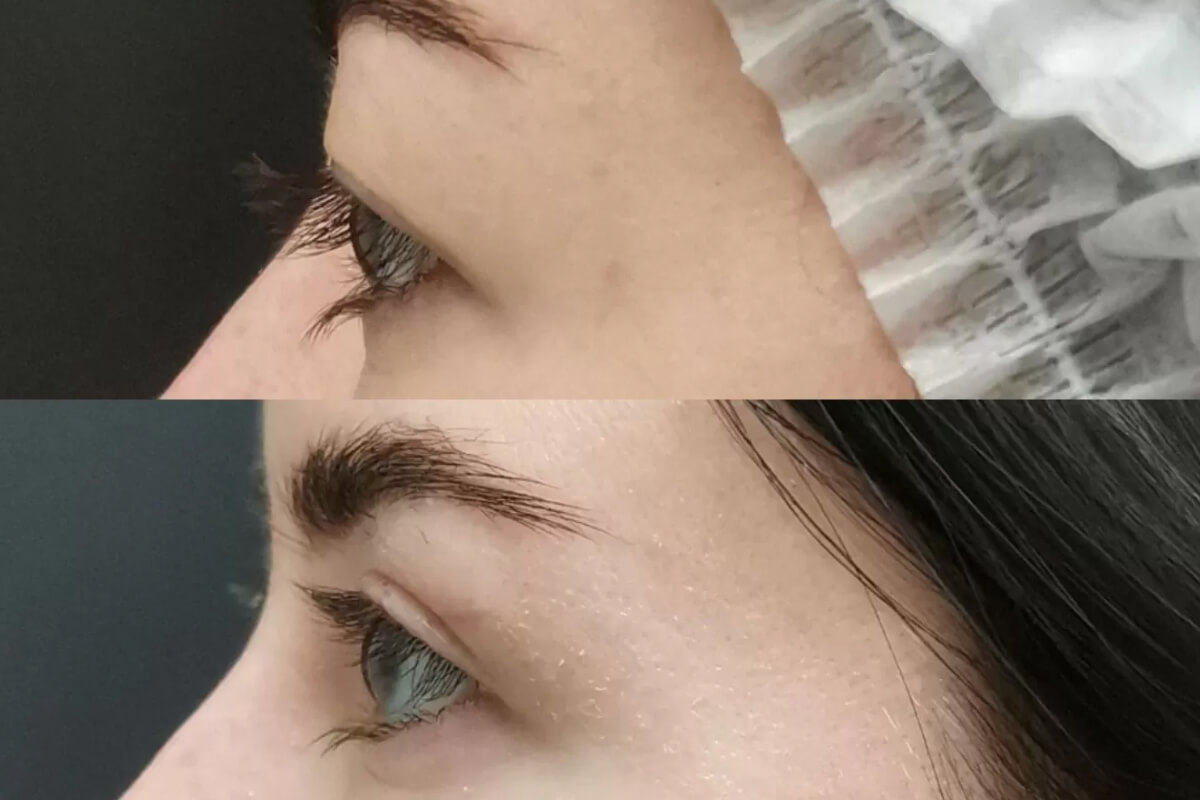 Нижняя блефаропластика 01