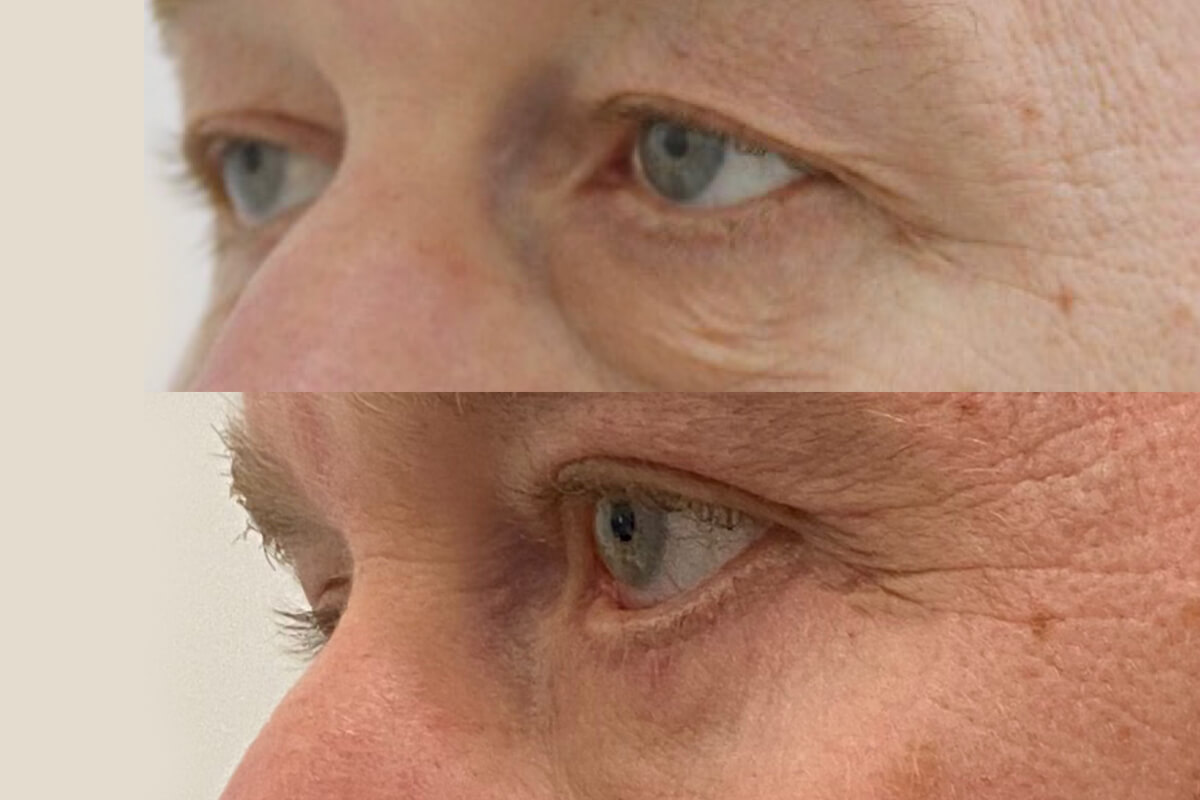 Нижняя блефаропластика 01