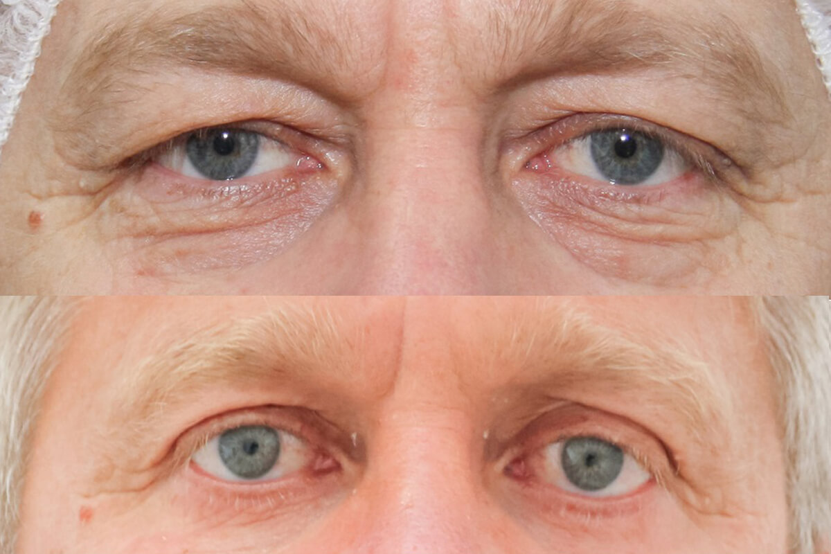 Нижняя блефаропластика 01