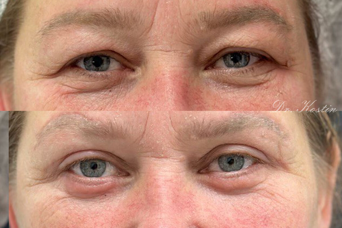 Нижняя блефаропластика 01