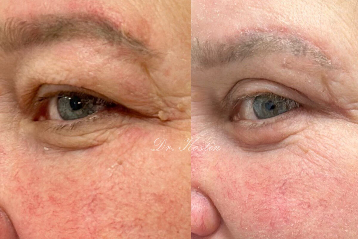 Нижняя блефаропластика 01