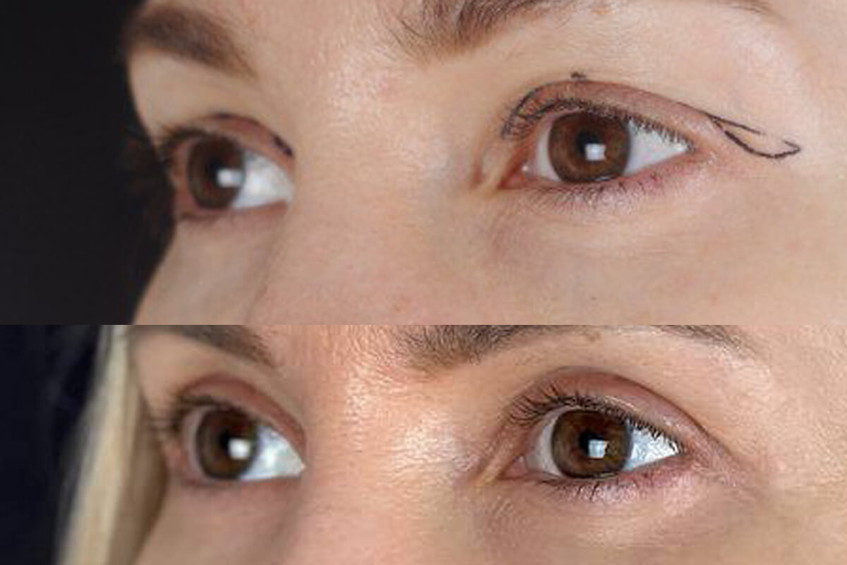 Нижняя блефаропластика 01