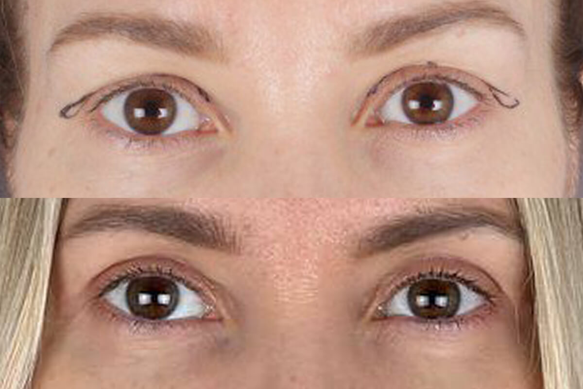 Нижняя блефаропластика 01