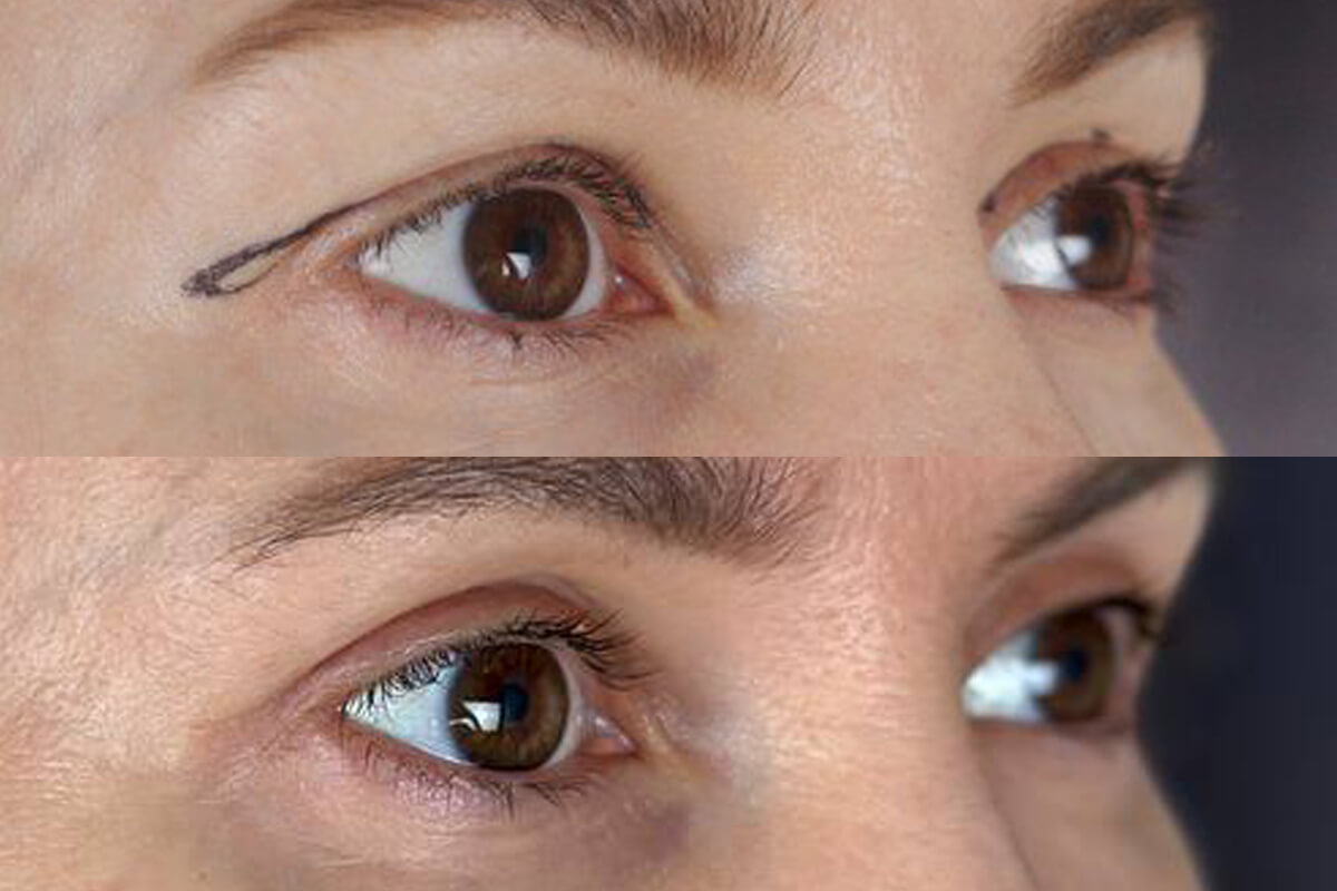 Нижняя блефаропластика 01