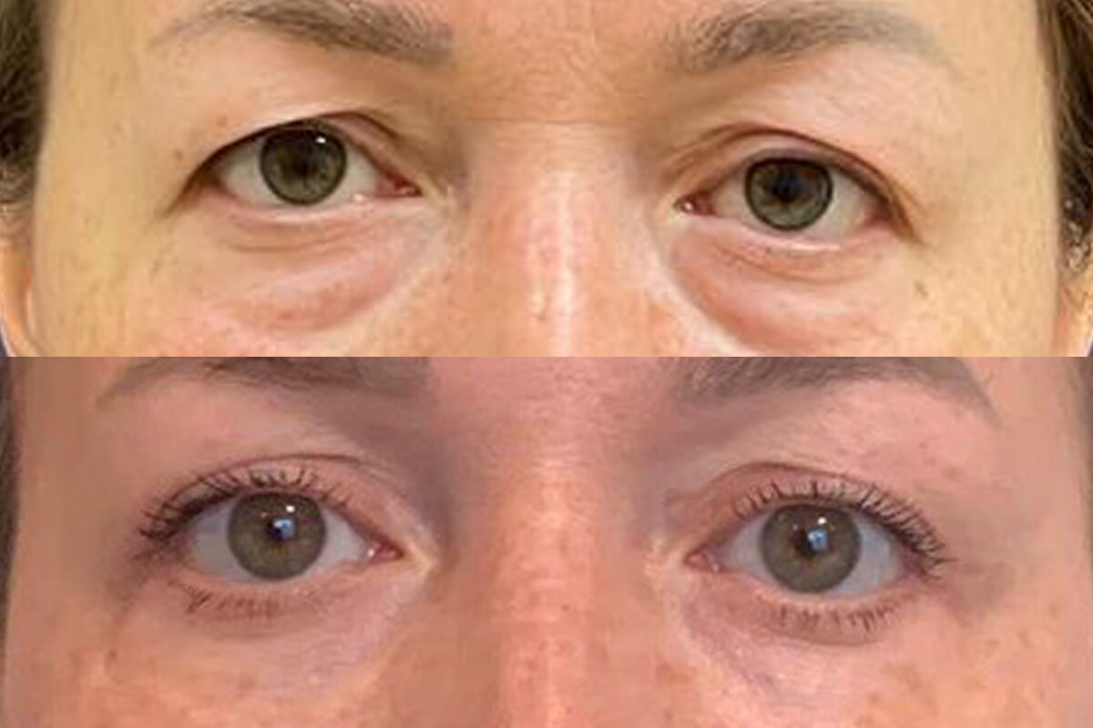 Нижняя блефаропластика 01