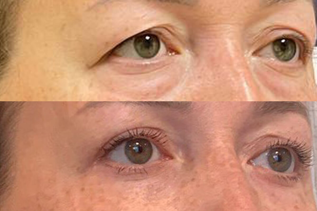 Нижняя блефаропластика 01