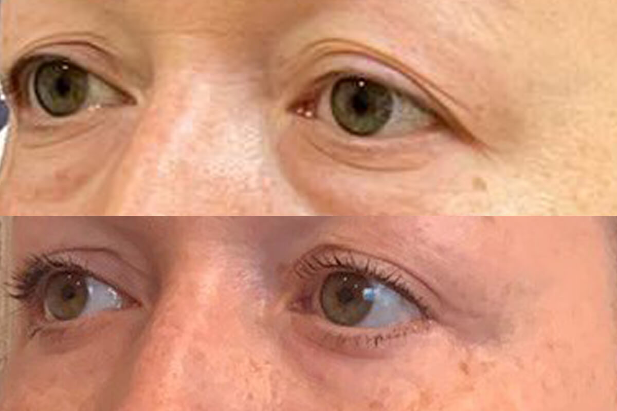 Нижняя блефаропластика 01