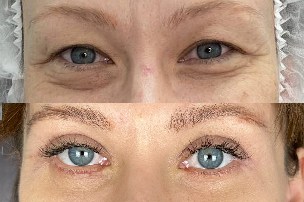 Нижняя блефаропластика 01