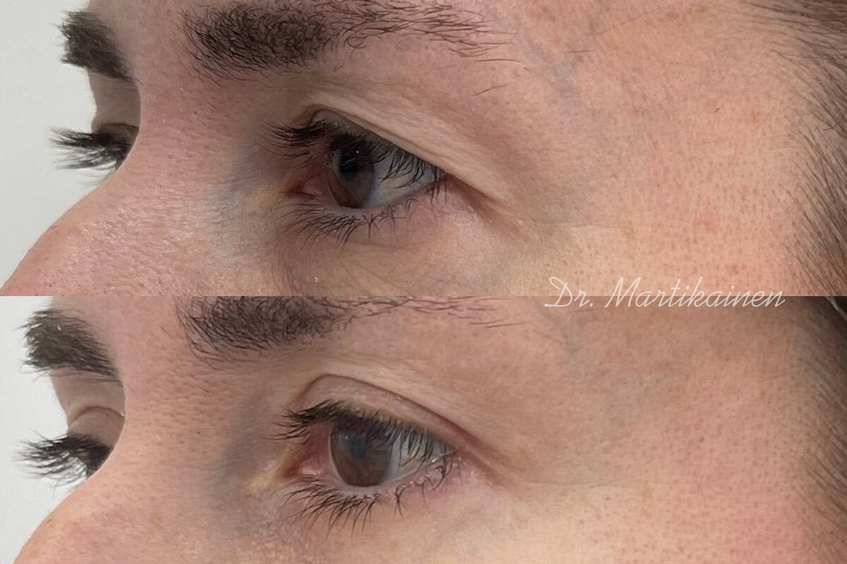 Нижняя блефаропластика 01