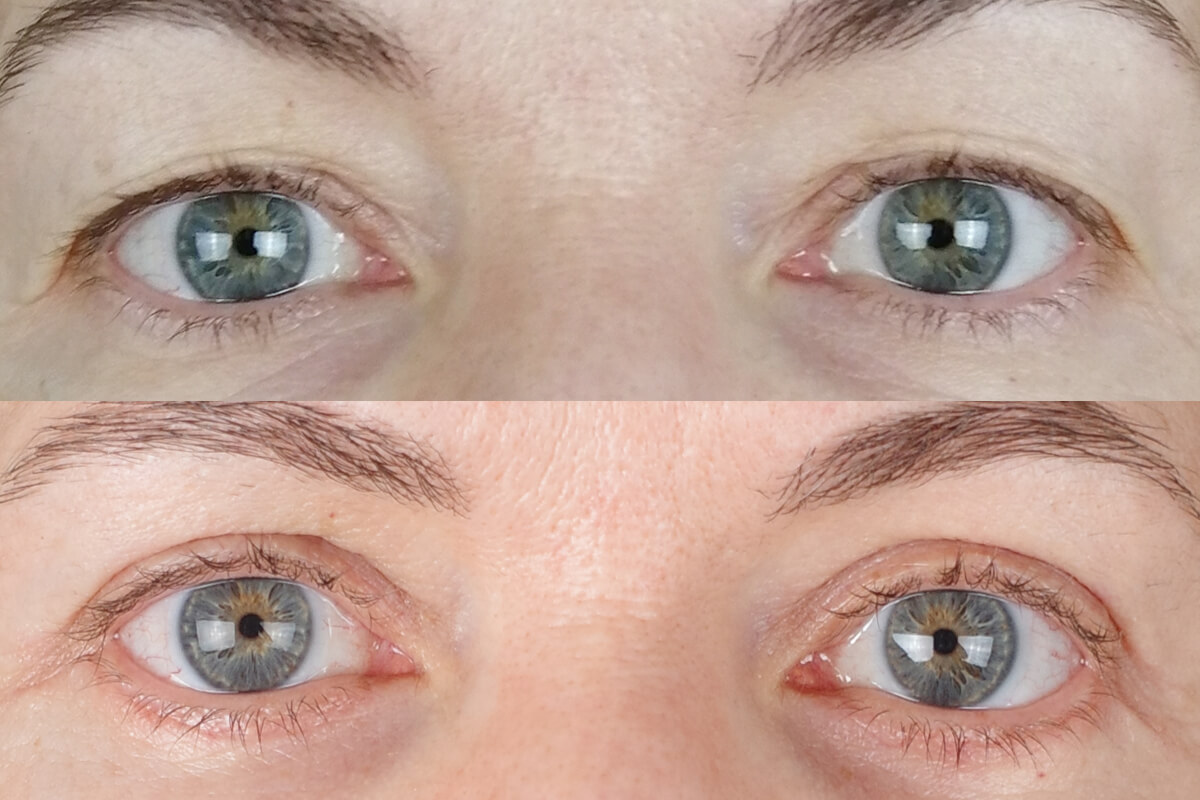 Нижняя блефаропластика 01