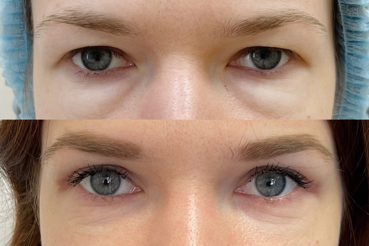 Нижняя блефаропластика 01