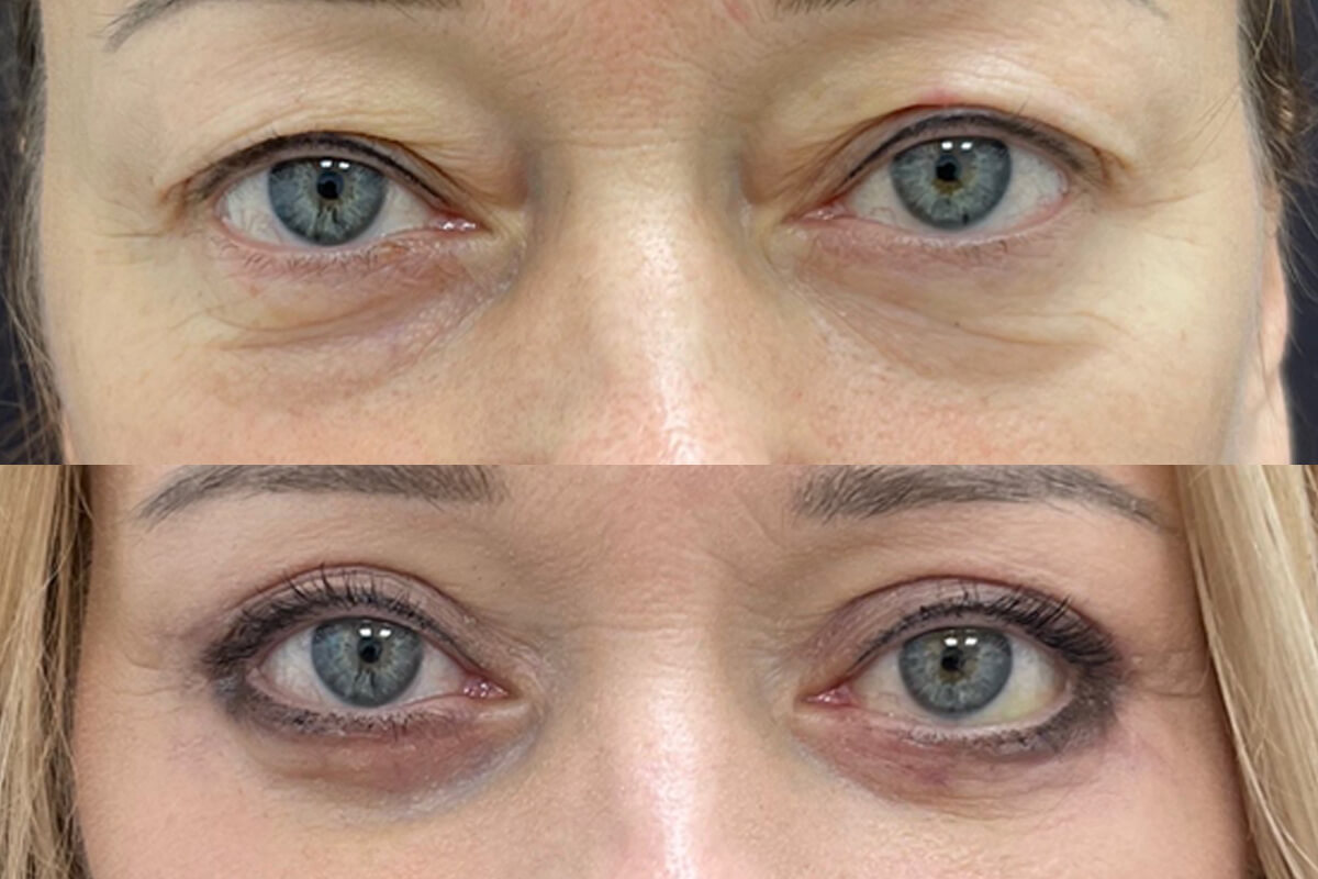 Нижняя блефаропластика 01