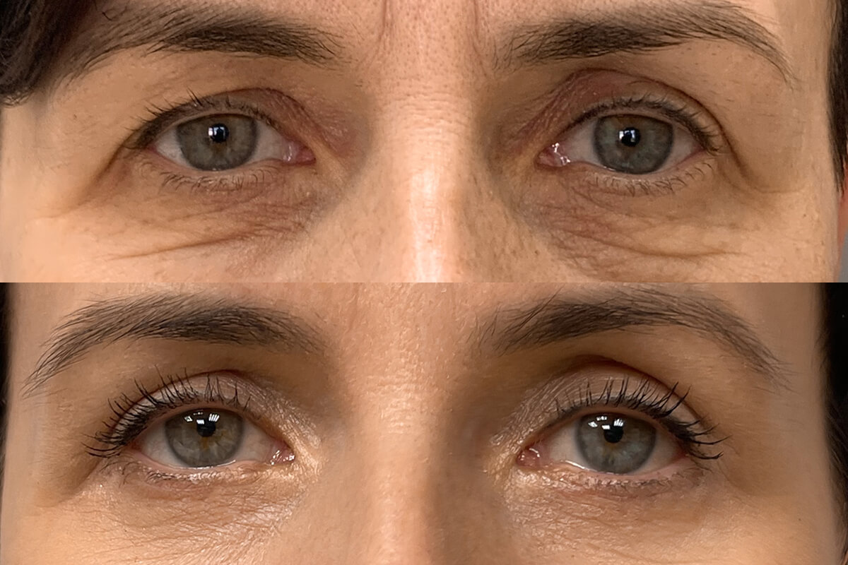 Нижняя блефаропластика 01