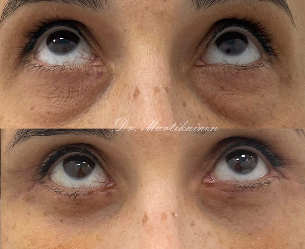 Нижняя блефаропластика 01