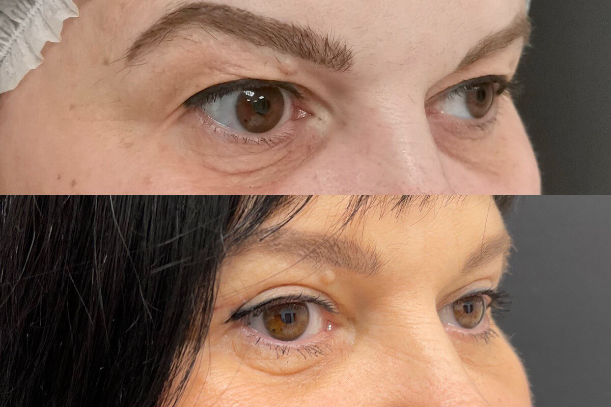 Нижняя блефаропластика 01