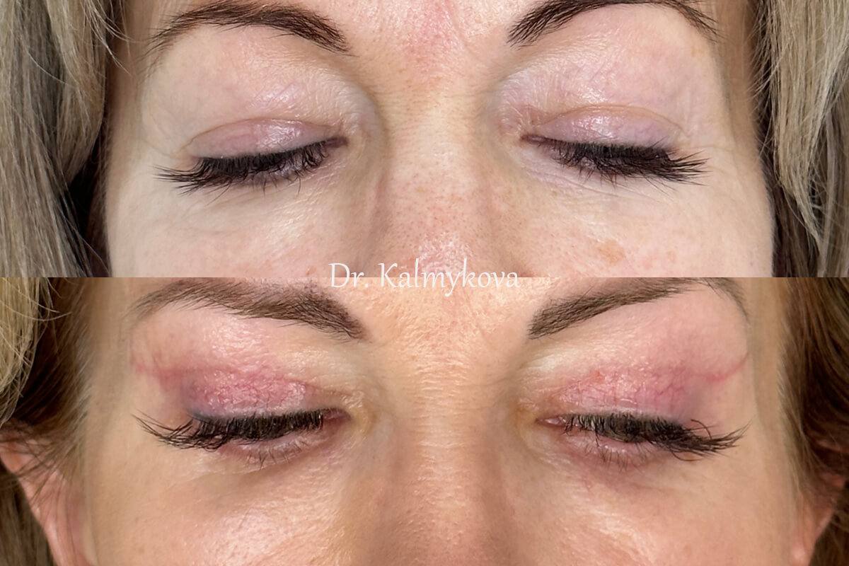 Нижняя блефаропластика 01