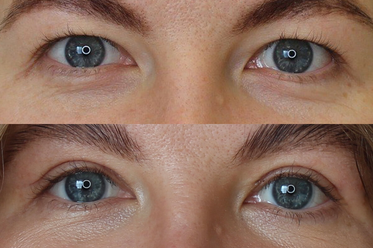 Нижняя блефаропластика 01