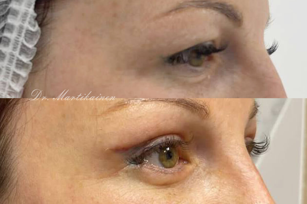 Нижняя блефаропластика 01