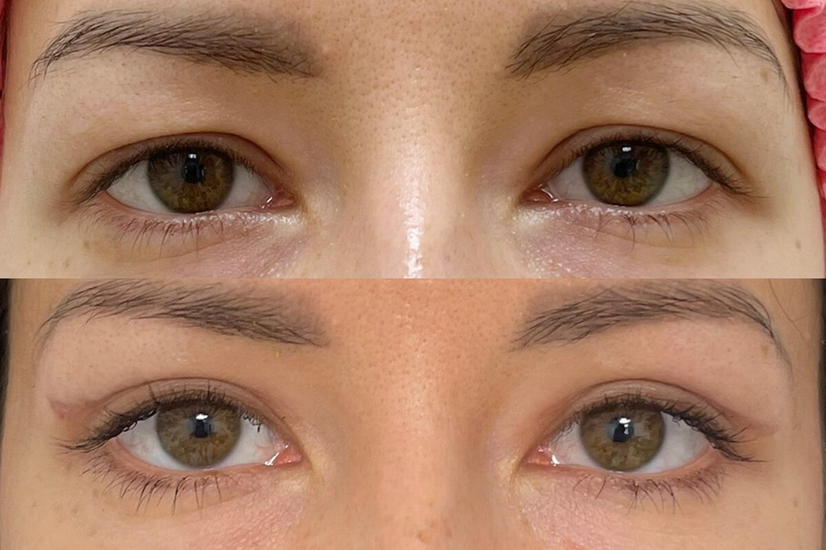 Нижняя блефаропластика 01