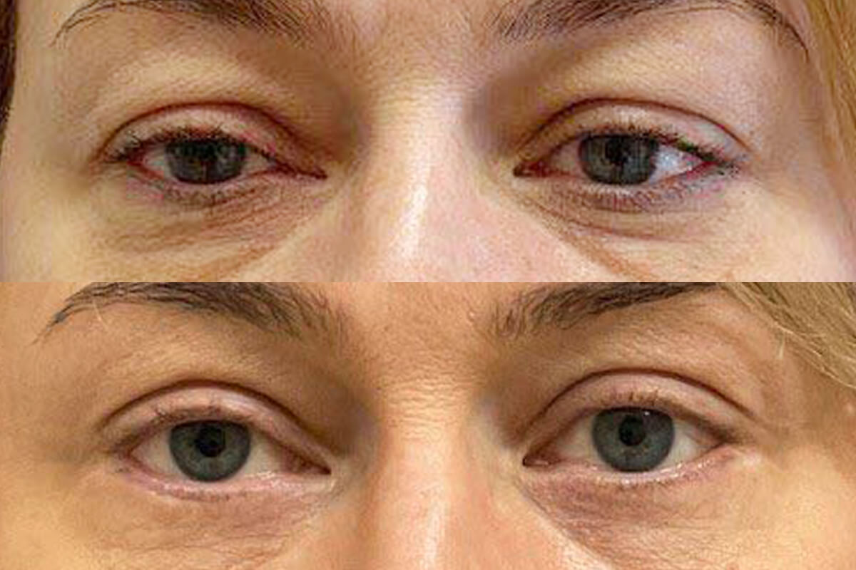 Нижняя блефаропластика 01