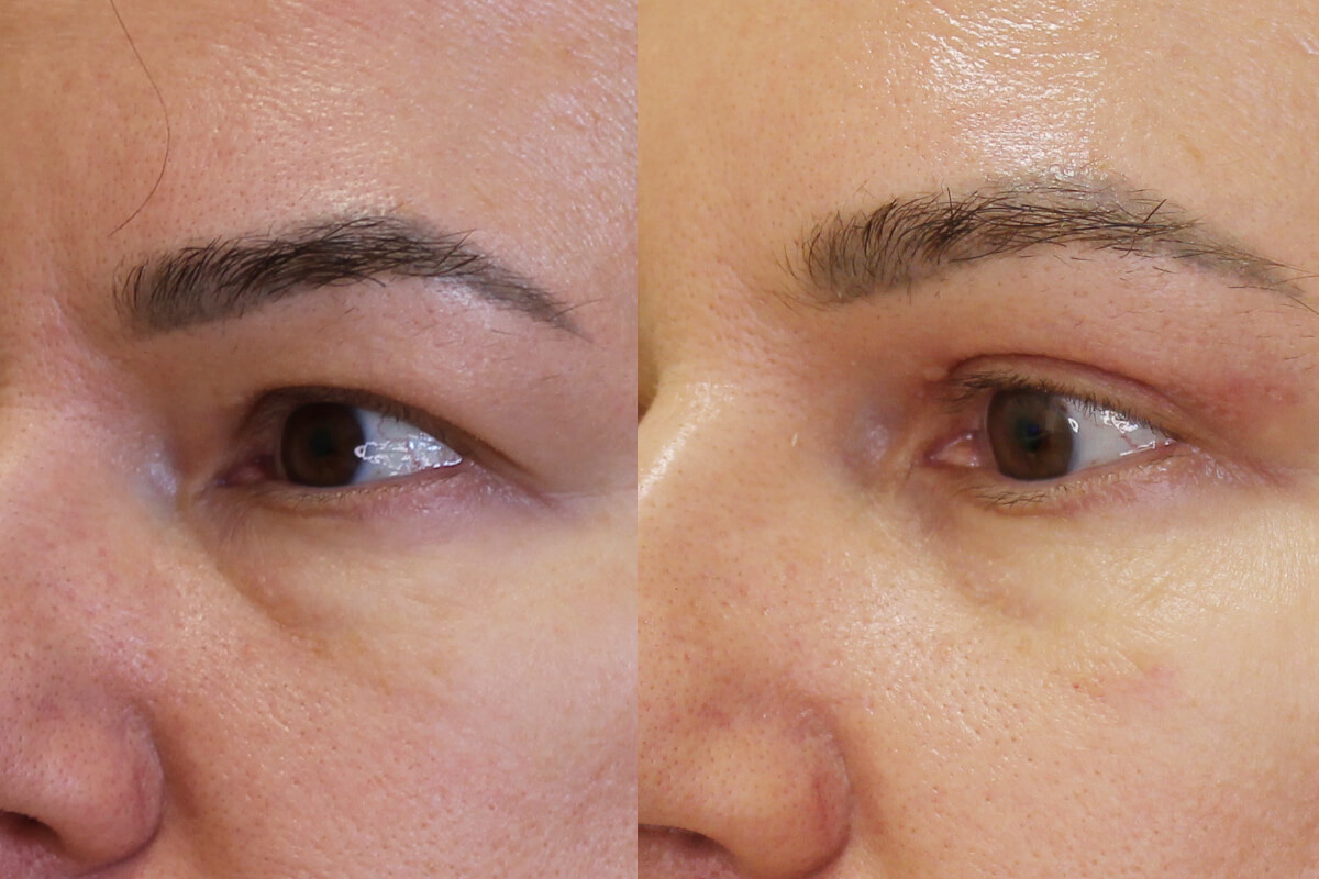 Нижняя блефаропластика 01