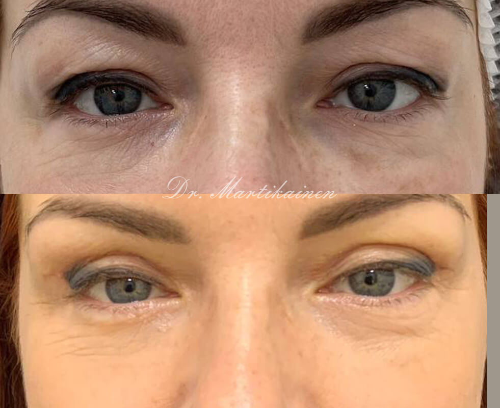 Нижняя блефаропластика 01