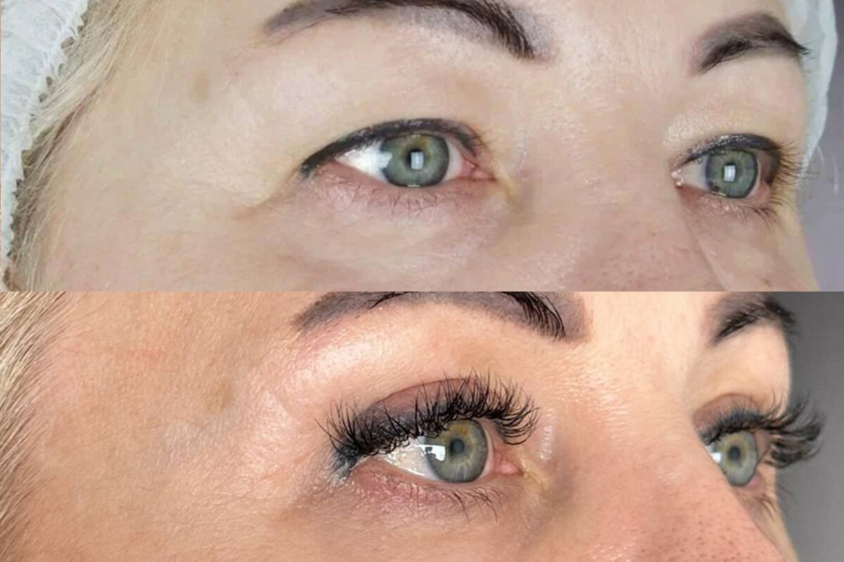 Нижняя блефаропластика 01