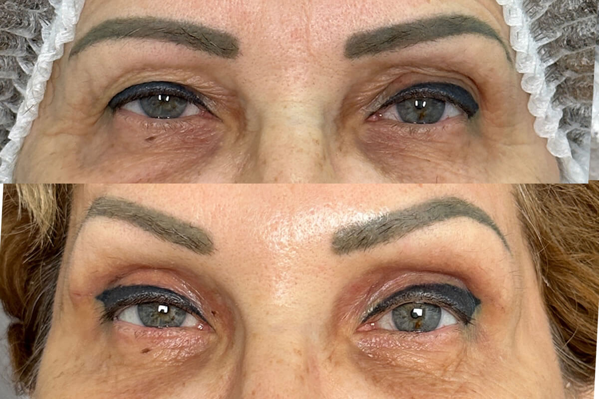 Нижняя блефаропластика 01