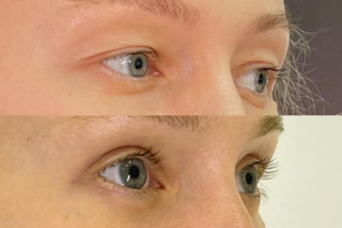 Нижняя блефаропластика 01