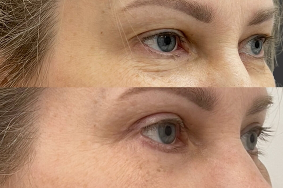 Нижняя блефаропластика 01